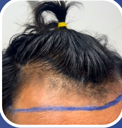 Paciente antes do transplante capilar, com marcação da linha