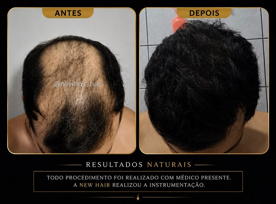 Card oficial de antes e depois New Hair