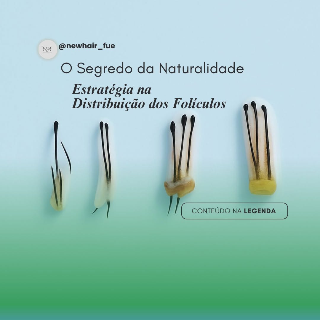 Unidades foliculares classificadas por quantidade de fios