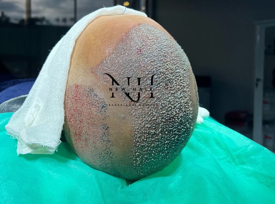 Área receptora implantada